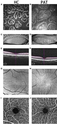 Altered Spontaneous Brain Activity Patterns of Meibomian Gland Dysfunction in Severely Obese Population Measured Using the Fractional Amplitude of Low-Frequency Fluctuations